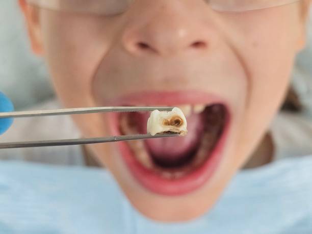 Best Emergency Dentist for Lost Fillings or Crowns in Lake Fenton, MI